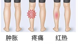 血栓来势汹汹!精准医治重获畅通