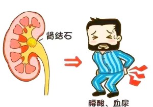 别让“石头”堵住健康路！输尿管结石预防全攻略