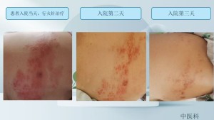 带状疱疹之痛，看中医火针如何发挥作用
