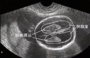 精准产前诊断，护航生命起点—— 一例胎儿侧脑室增宽案例的全程管理