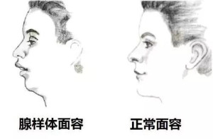 孩子张口呼吸、打呼噜？警惕腺样体肥大的隐形伤害！