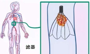 植入静脉滤器后,如何科学进行自我管理?