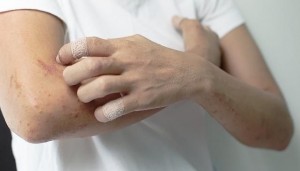 血液透析患者该如何预防皮肤瘙痒？