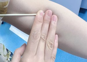 抽血后正确按压,告别手臂淤青