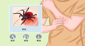 藏在草丛里的“隐形刺客”——恙虫病