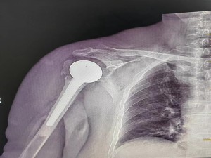 攻“肩”克难，宁南县人民医院成功开展一例肩关节置换术！