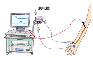 肌肉与神经的沟通密码——肌电图检查