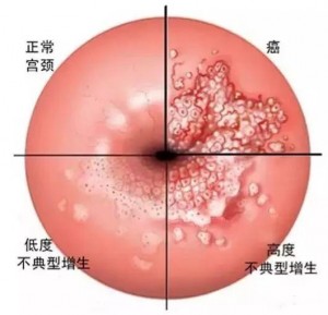 防治宫颈癌，让女人花永远绽放