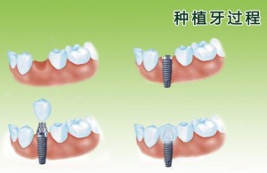 想种牙？往这里看