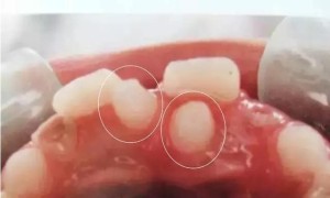 关注多生牙，守护儿童牙齿健康