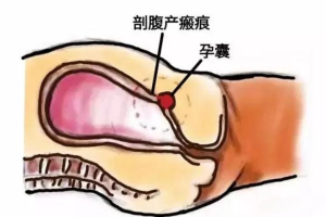 剖宫产疤痕上的“危险孕事”