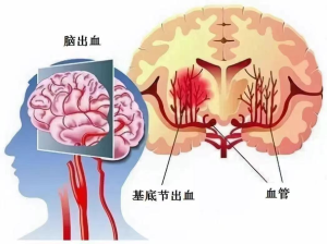 夏季高血压脑出血，一个被误解的“安全季”
