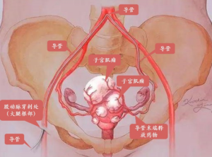 子宫肌瘤的介入治疗——子宫动脉栓塞术