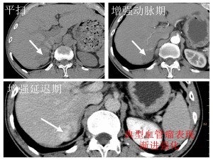 CT增强扫描介绍及临床意义