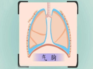 看不见的“致命气胸”随时在发生，遇到气胸应该怎么治？