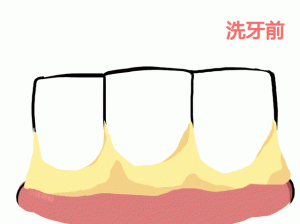 大家都说洗牙不好，那我就不洗了?
