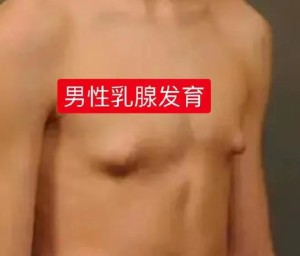 尴尬了！男性乳房发育，小心是种“病”……