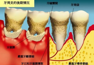 牙齿变长牙缝变宽...注意！你的牙龈正在萎缩！